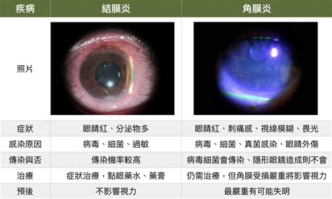 眼睛周圍紅腫|結膜炎會自己好嗎？原因、症狀、前兆、是否會傳染